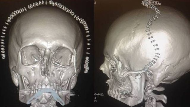 A férfi koponyája a műtét után, Forrás: bbc.com