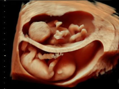 3D-s ultrahang: mintha kamerával néznénk be az anyaméhbe