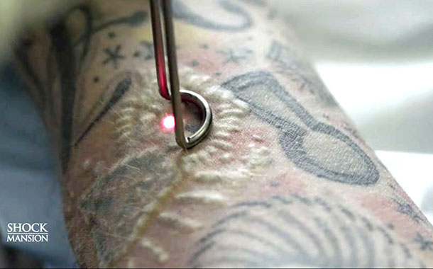 Így néz ki a tetoválás-eltávolítás - fotók