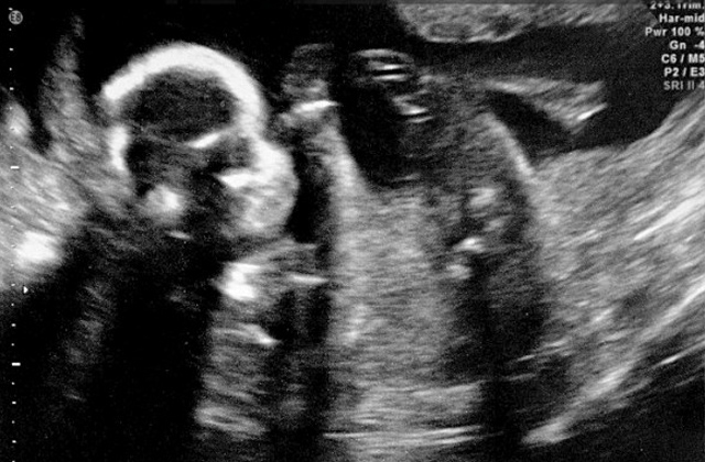 Ultrahang felvétel alapján nevezte a babáját szépségversenyre
