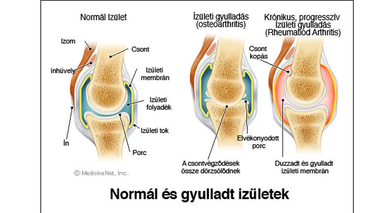 fájdalom a bal vállízület kezelésében csípőfájdalom átjut a lábába