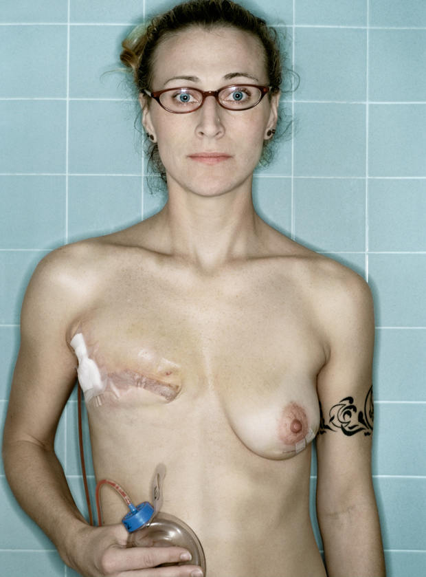 Megrázó fotókat készített magáról egy mellrákos nő