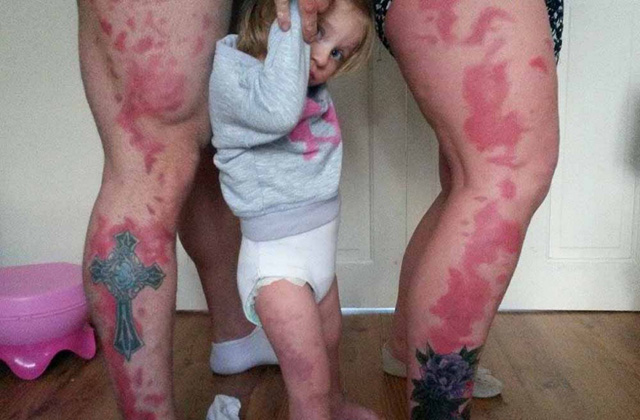 Magukra tetováltatták a szülők a kislányuk hatalmas anyajegyét