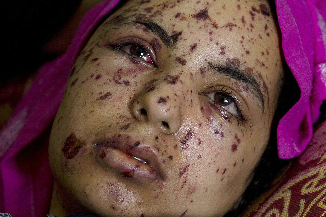 Rawya abu Joma egy légi csapásban sérült meg, a 17 éves palesztin lány arcát törmelék okozta sérülések borítják (Fotó: Heidi Levine)