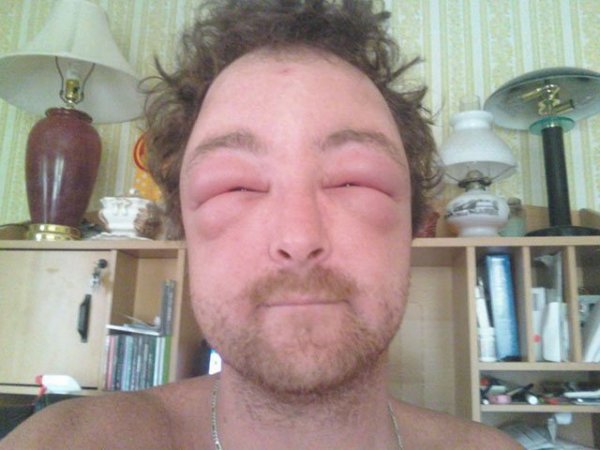 Bedagadt fejek: allergiás szelfik - ez az új őrület