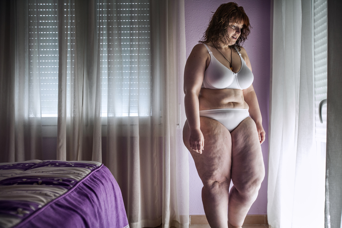 Több, mint 50 kilótól szabadult meg gyomorműtéttel a fiatal nő - fotók