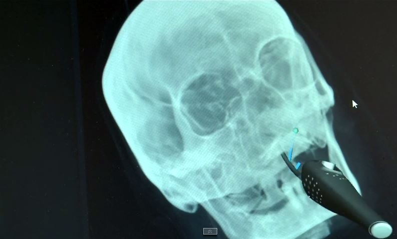 Az orvos okosszemüvegen keresztül pontosan látja, hova kerül az implantátum (Fotó: Cambridge Consultants)