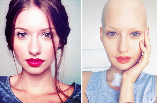 Elizveta a kemoterápia előtt és után