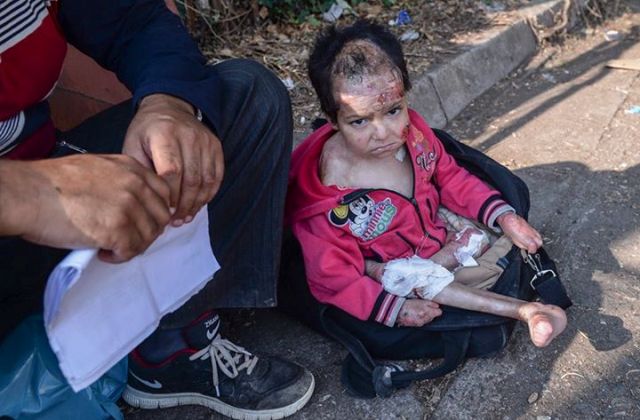 Élet-halál között a bombázásban megsérült négyéves kisfiú
