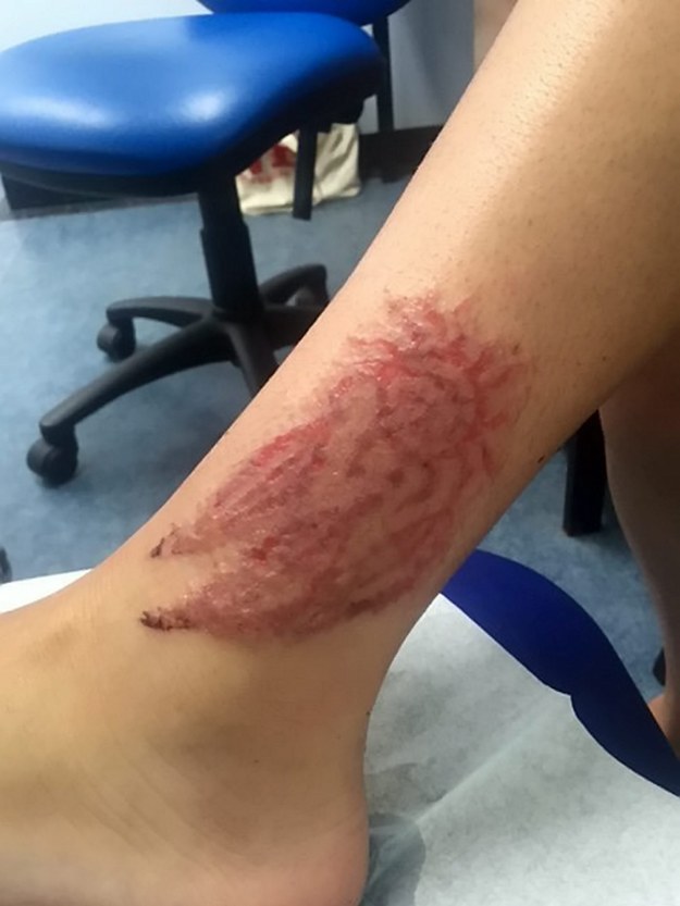 Horror lett a nyaralásból! Szétégette bőrét a henna tetoválás
