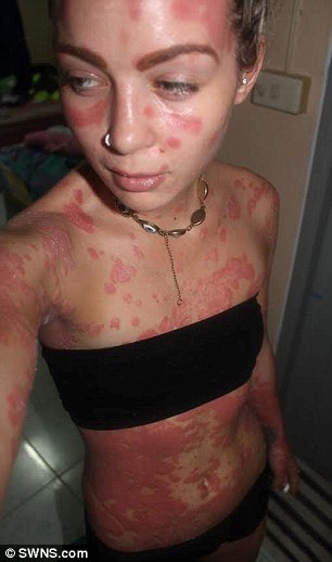 Elege lett a csúfolódásból, ezért megmutatta súlyos bőrbetegségét a fiatal nő