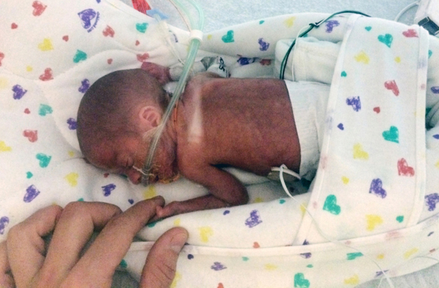 Életben maradt az 5 hónapra született baba