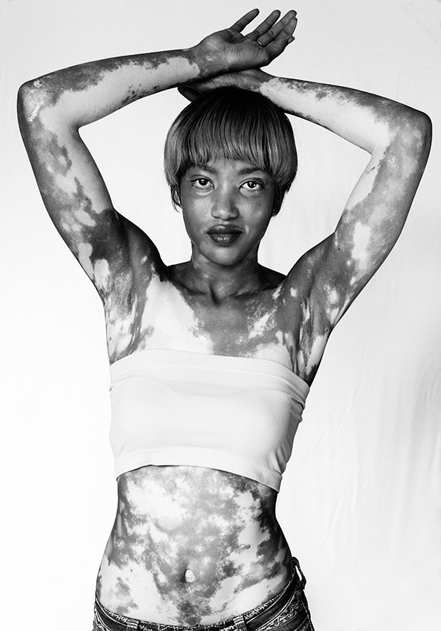 Lásd meg te is a vitiligo szépségét!