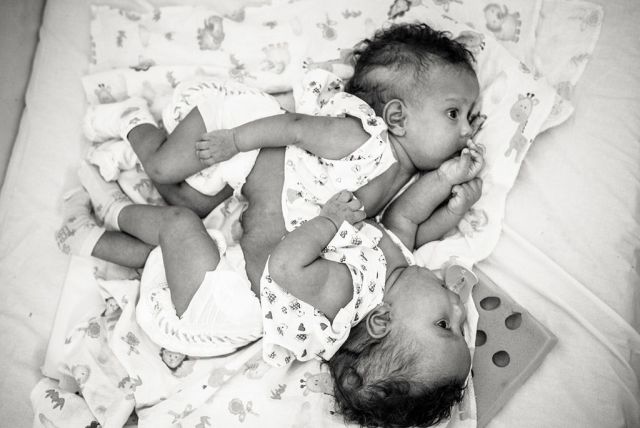 Hatórás műtéttel választották szét a sziámi iker babákat - megható képek