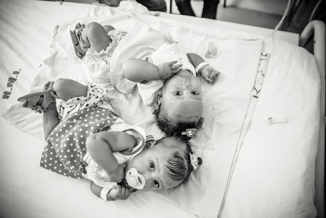 Hatórás műtéttel választották szét a sziámi iker babákat - megható képek