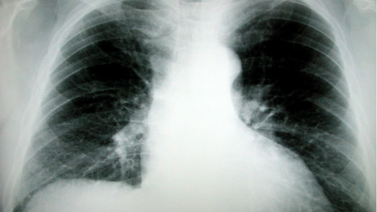 Tüdőfibrózis: nehezen ismerhető fel a gyilkos kór 