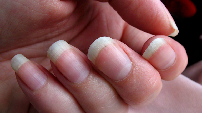 köröm gombás korai szakaszában kezelés nail fungus propolis