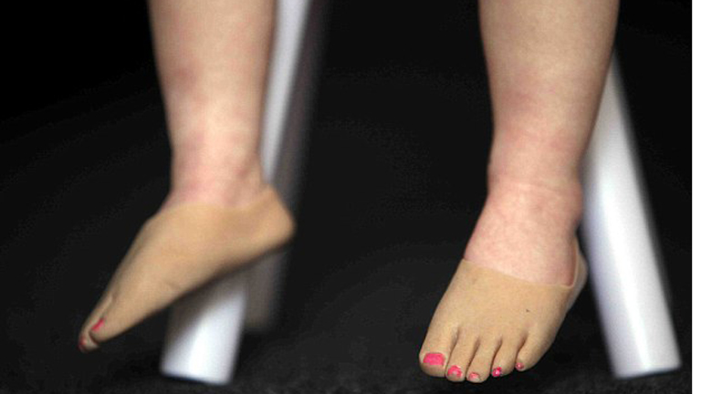 Élethű lábfejeket kapott a cuki kislány