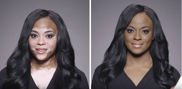 A vitiligo arcai: hihetetlen átváltozás némi smink segítségével
