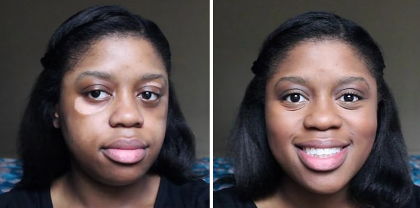 A vitiligo arcai: hihetetlen átváltozás némi smink segítségével