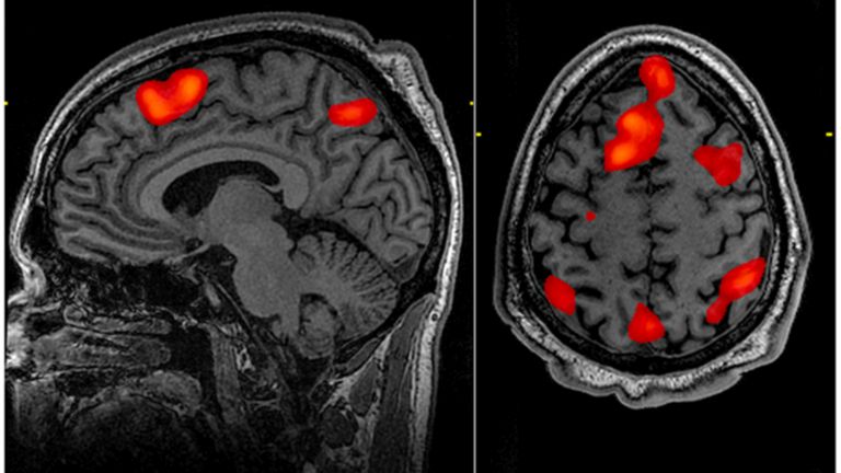 MRI közben megfigyelhetők az éppen aktív agyterületek