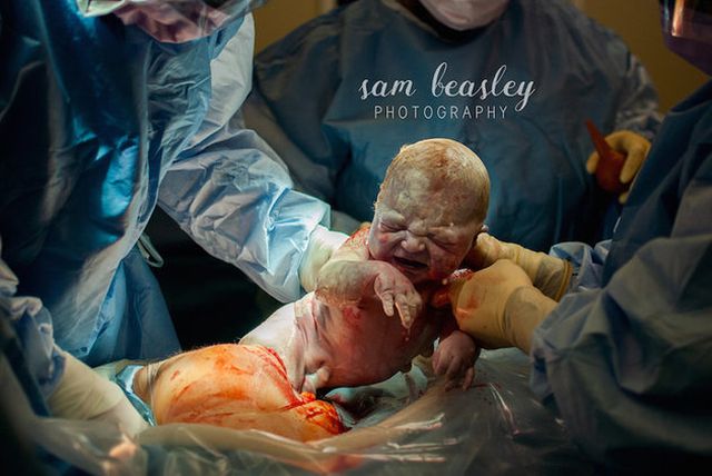 A császármetszés is lehet gyönyörű szülésélmény - megható fotók