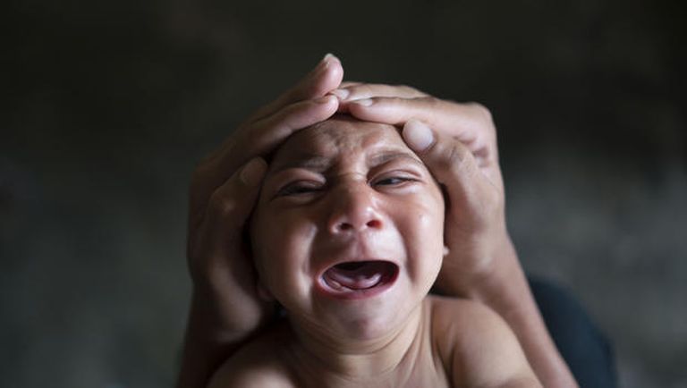 A kisfejűségben szenvedő csecsemők szinte állandóan sírnak