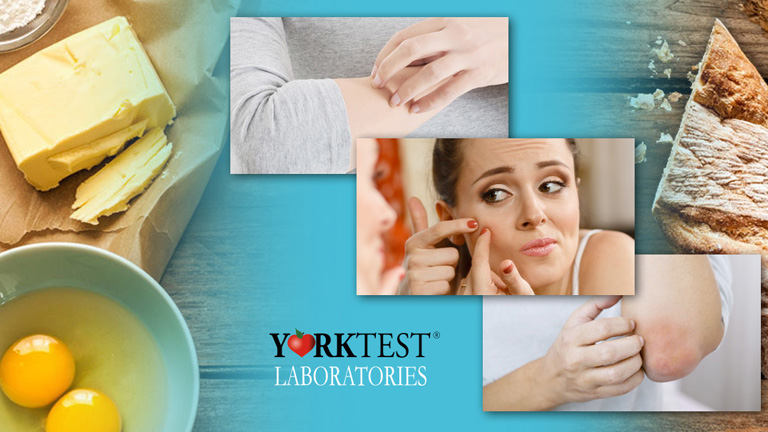 Optimalizáld diétádat a YorkTest ételintolerancia program segítségével!