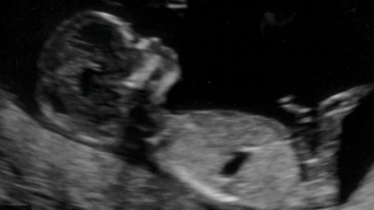 Rutin vizsgálat miatt vesztette el születendő gyermekét egy nő