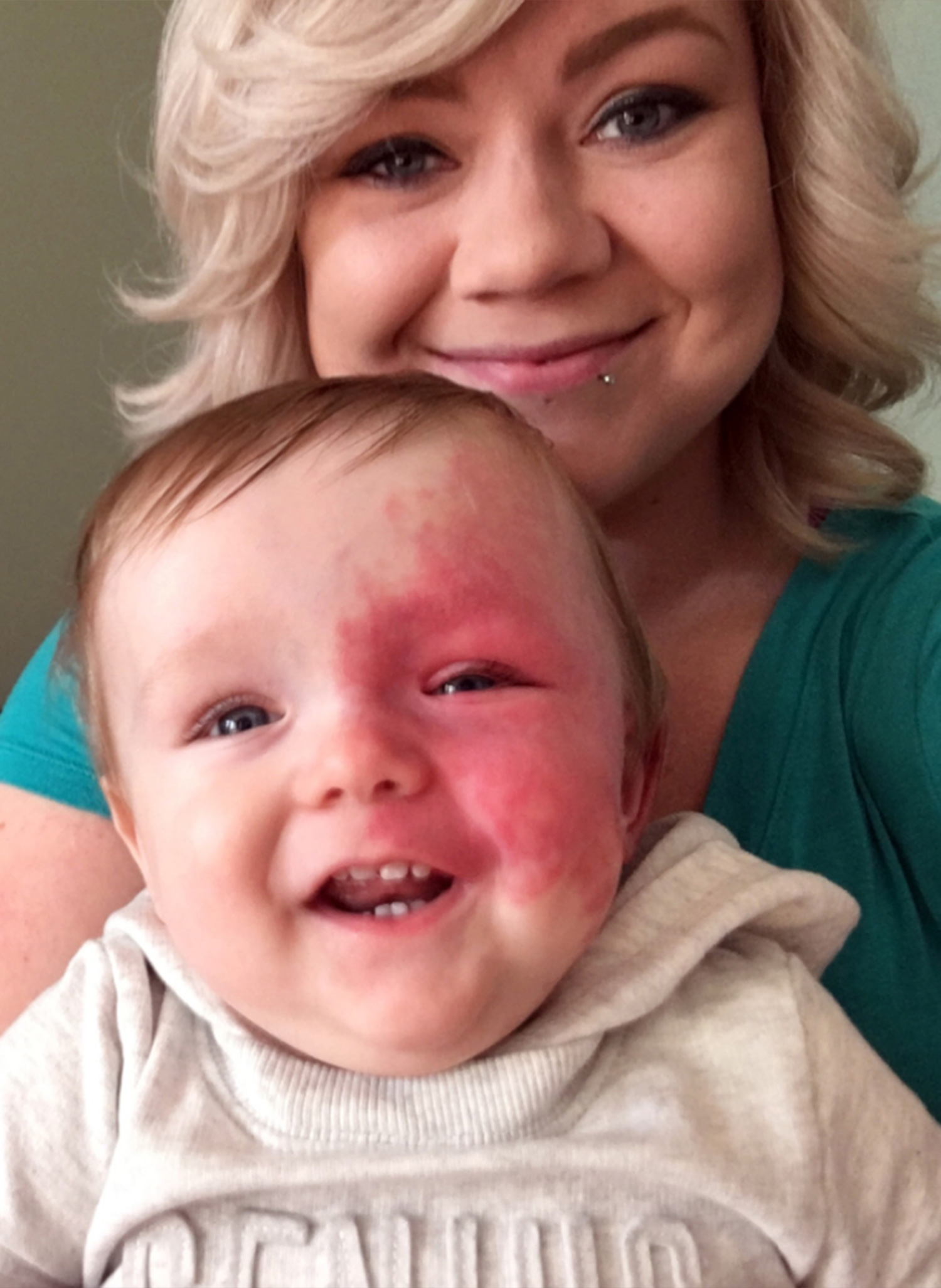 Nem engedi eltávolítani kisfia arcáról a hatalmas születési foltot az anyuka - fotók
