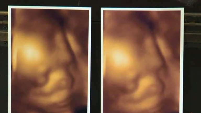 Ugyanazt az ultrahang felvételt adta a kismamáknak egy klinika