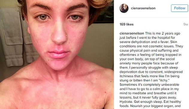 Hősként ünnepli az internet a bőrbeteg nőt, aki megmutatta magát smink nélkül 