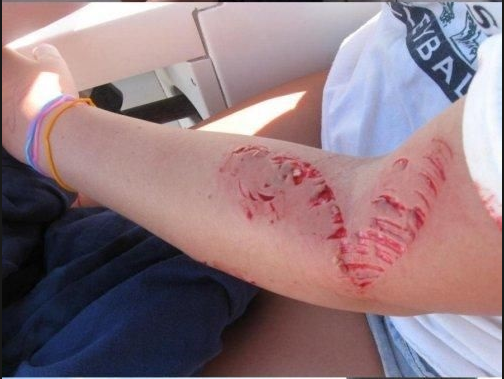 Halszörny harapdálta össze a 14 éves lány karját