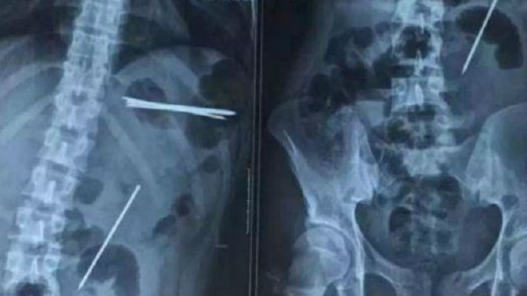 15 centis szögeket evett a férfi, hogy lenyűgözze barátait - kórházba került