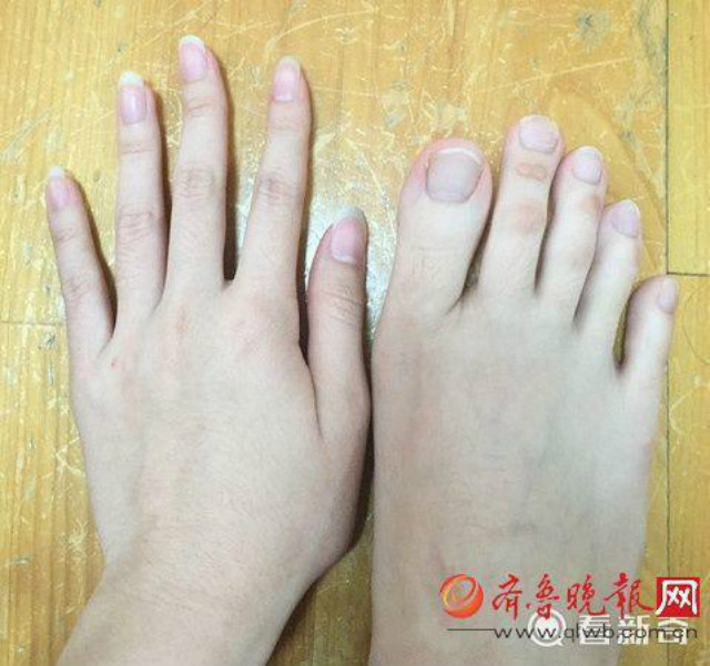 Bizarr lábujjai miatt lett netes sztár a tajvani nő