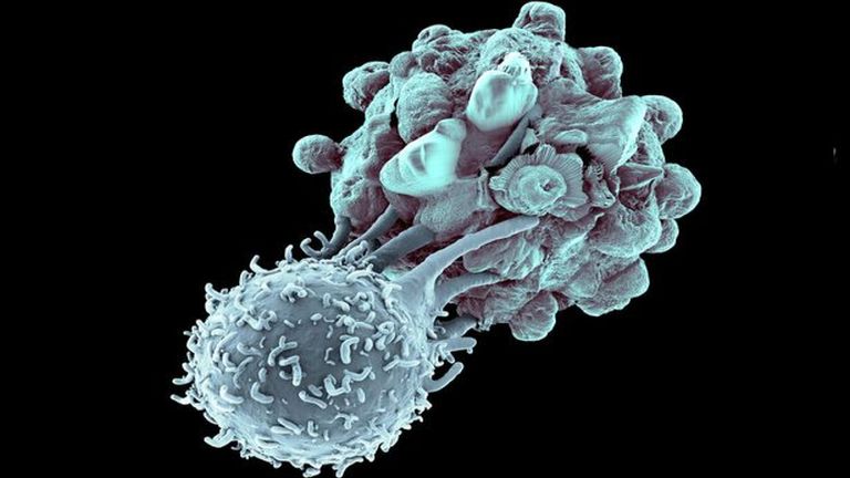 Radikálisan új módszerrel gyógyították meg a végső stádiumú rákbeteget
