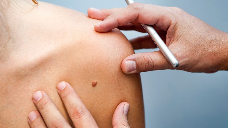 Hajlamos vagy a melanomára? – ebből a tesztből megtudhatod