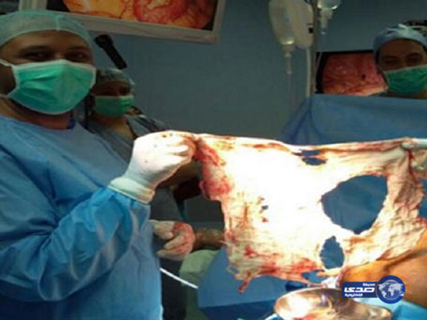 40 centis gézdarabot felejtettek műtétekor egy férfi hasában 