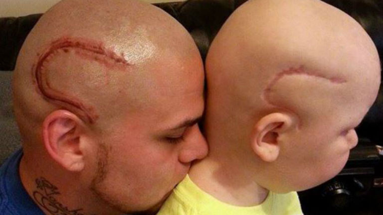 A fejére tetováltatta gyermeke sebhelyét a világ legjobb apukája