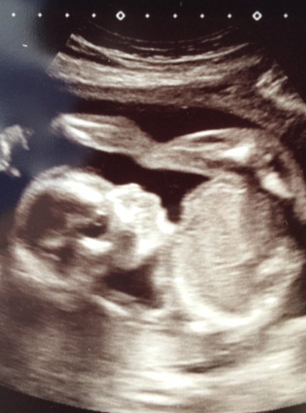 Halálra rémítette a kismamát a magzatáról készült horrorisztikus ultrahang-fotó