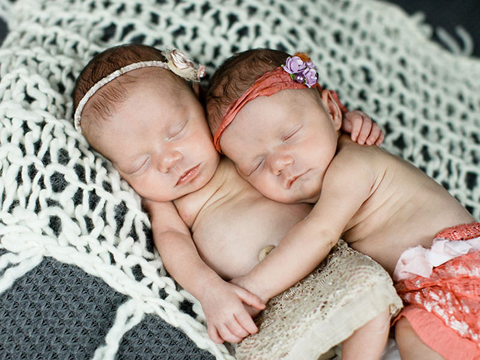 Két évvel születésük után is imádja egymást a kézenfogva született ikerpár