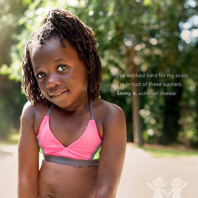 A túlélés hegei - Gyerekek mutatják büszkén a sebhelyeiket egy a fotósorozatban