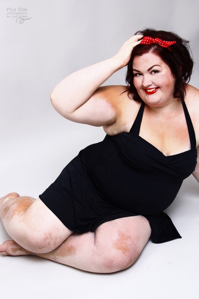 Gyönyörű fotók egy magyar vitiligós plus size nőről, akire öröm ránézni
