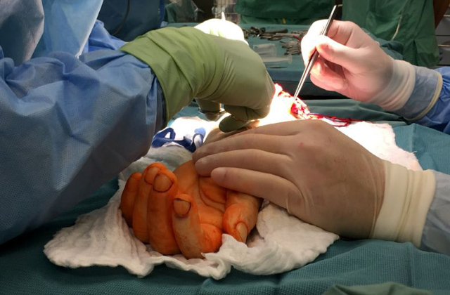 Donorkart kapott egy fél karral született férfi