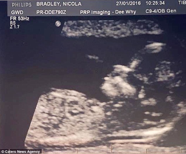 Már az ultrahangon is látszott a baba hatalmas haja!