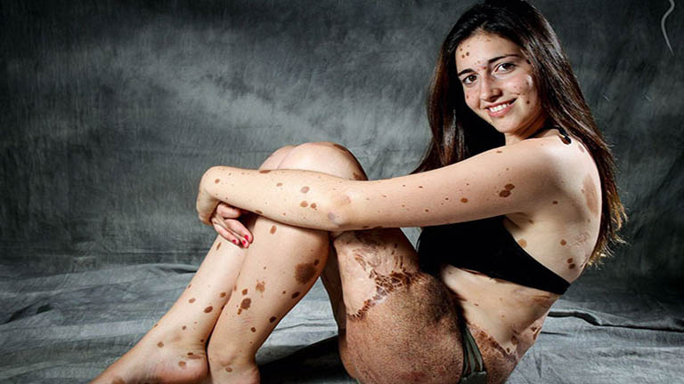 Csodaszép modell lett a bőrproblémái miatt zaklatott lányból