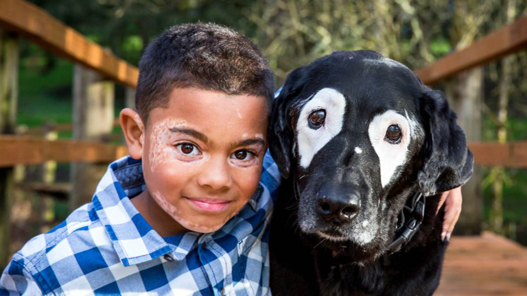A kutyából merített önbizalmat a vitiligós kisfiú