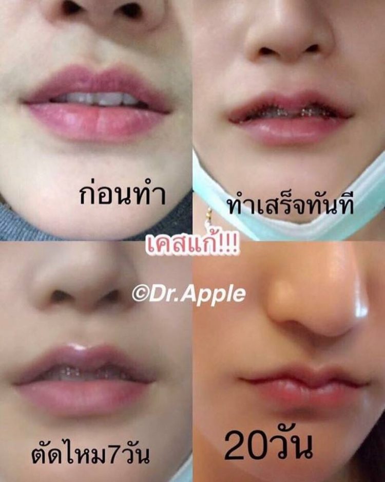 Bizarr formára műttetik ajkukat a thai nők