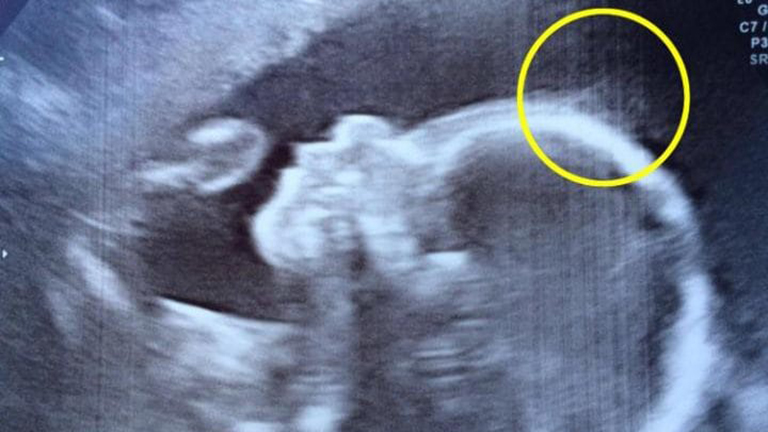 Már az ultrahangon látszódott a kisbaba hihetetlenül dús haja