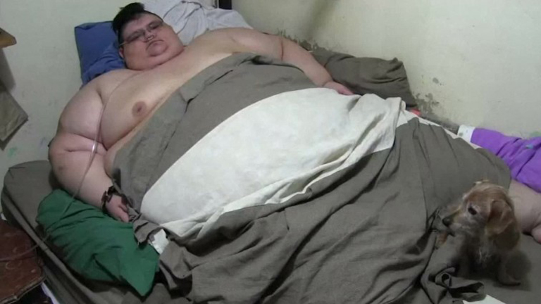 Vizespohárnyira zsugorították a világ legkövérebb emberének gyomrát